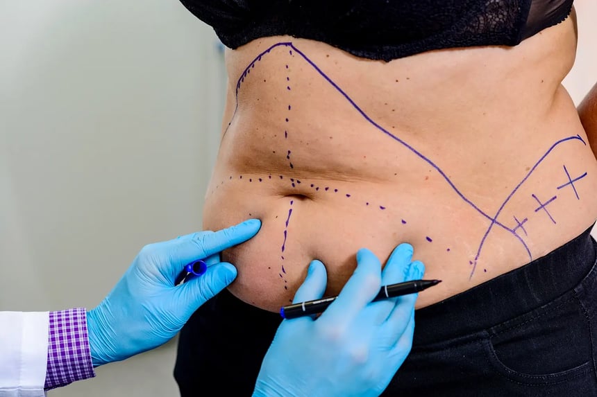 A doctor marking areas on a patient’s stomach before liposuction.