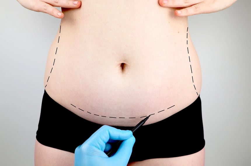 A surgeon assessing a patient’s stomach to determine a tummy tuck procedure