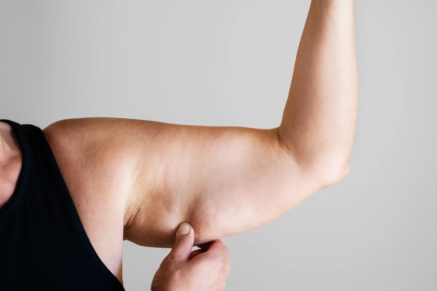 A woman showing excess fat on her arms