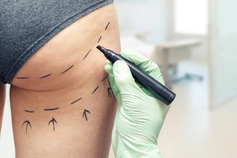 Plastic Surgery and Recovery