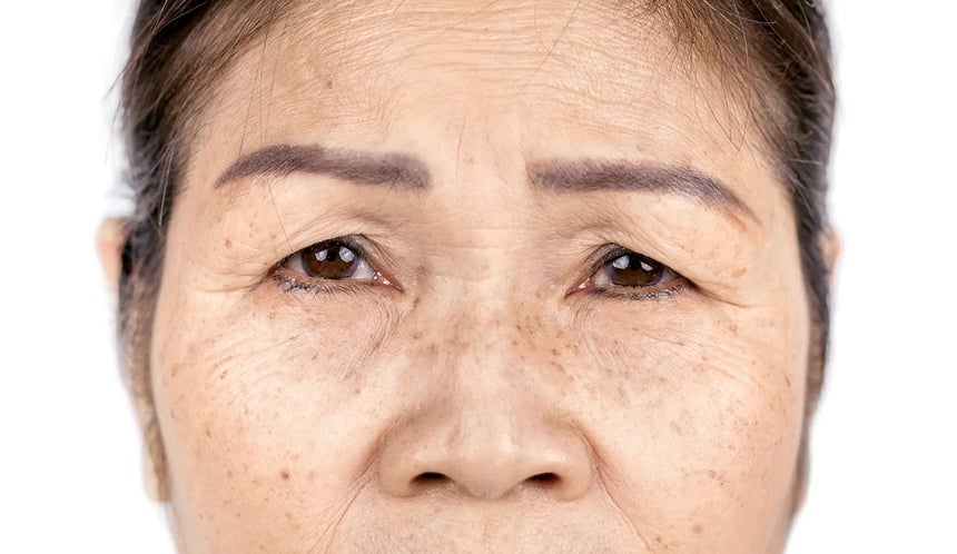 Close-up of a woman’s face with droopy eyelids