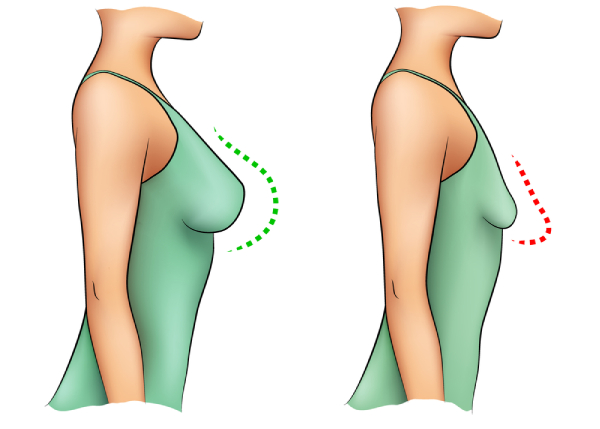saggy breast