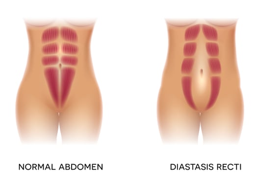 diastasis recti