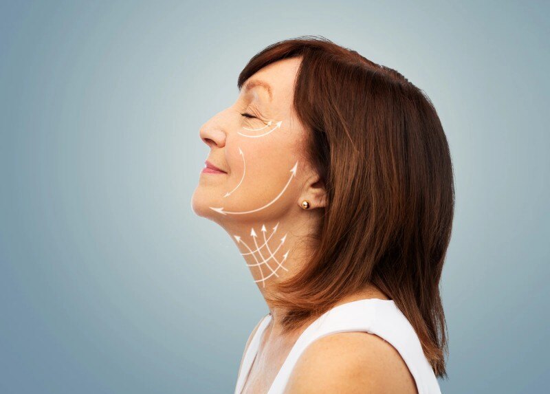 Facelift