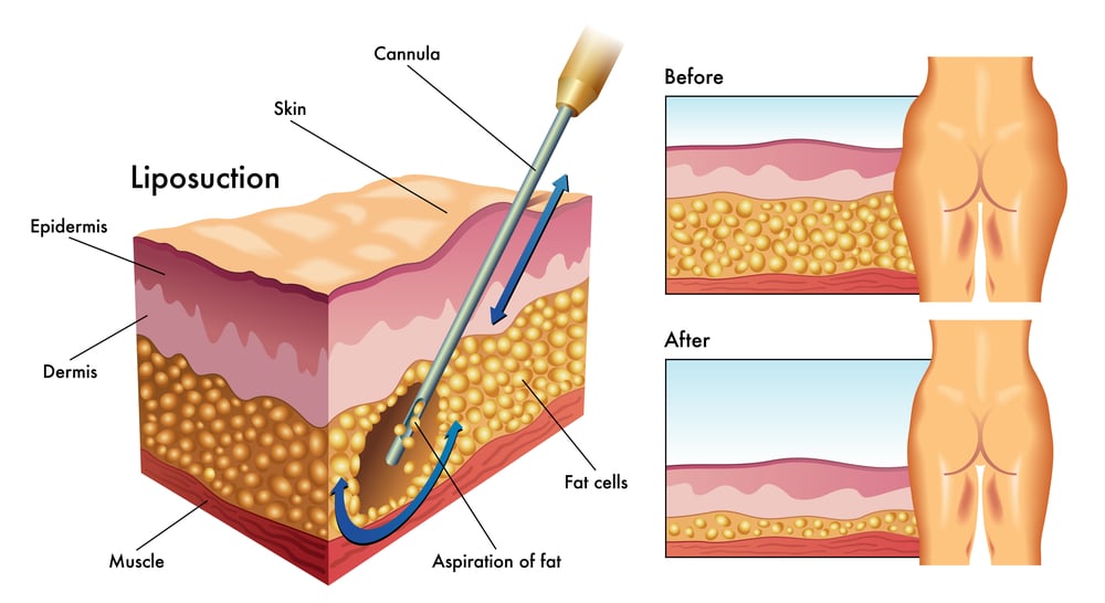 liposuction