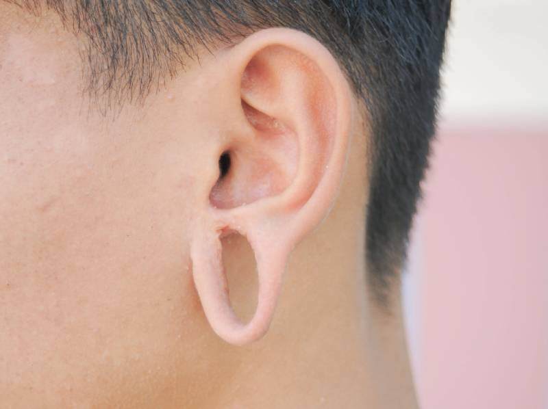 Ear Lobe Repair