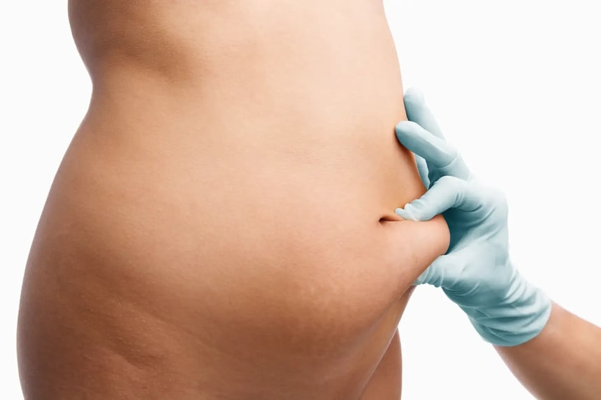 From Fat to Confident Why People Turn to Liposuction