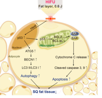 HIFU Decreasing Subcutaneous Fat Tissue Thickness