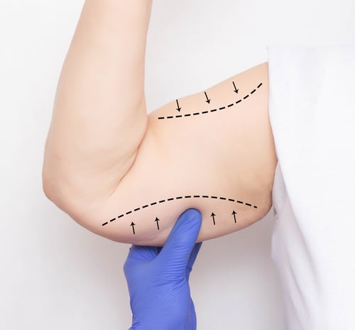Arm Lift