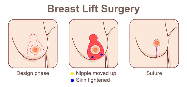 Breast Lift-2