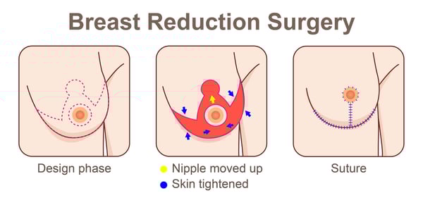 Breast Reduction-2