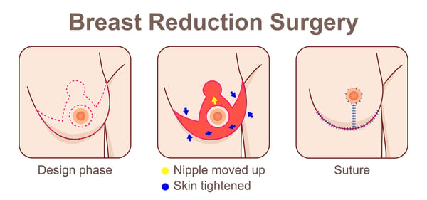 Breast Reduction-2