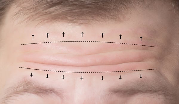 Brow and Forehead Lift