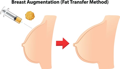 Fat Grafting to the Breast-2