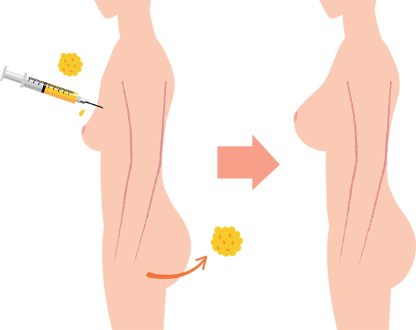 Fat-Grafting-to-the-Breast-procedure