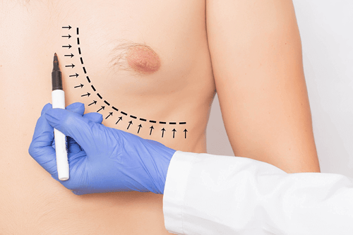 Gynecomastia Procedures