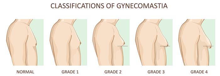 Gynecomastia Surgery-1_PNG