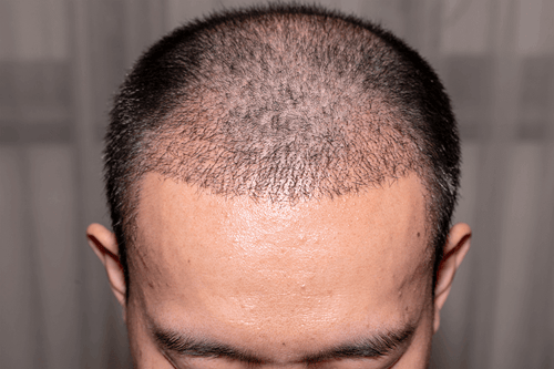 Hair transplant