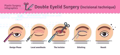 Incisional Double Eyelid Creation