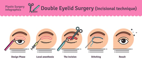 Incisional Double Eyelid Creation