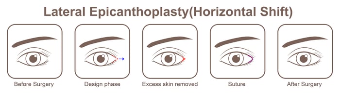 Lateral Epicanthoplasty_Horizontal Shift