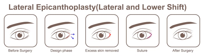 Lateral Epicanthoplasty_lateral and lower shift