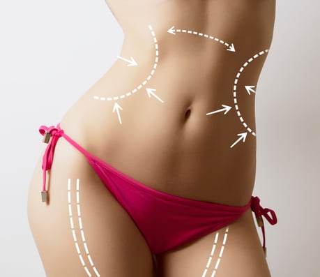 Liposuction