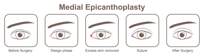 Medical Epicanthoplasty