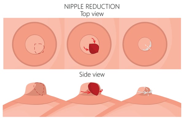 Polaris - Nipple and Areola Reduction