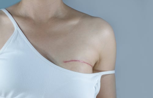 Polaris-Breast reconstruction-1-1