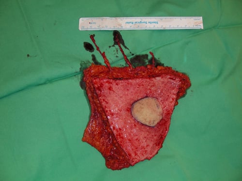 Polaris-Breast reconstruction-2