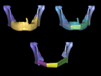 Polaris-Mandibular and tongue reconstruction-1