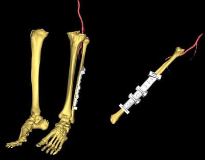 Polaris-Mandibular and tongue reconstruction-2
