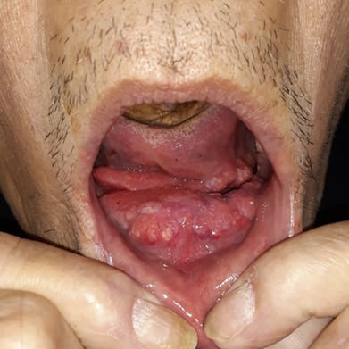 Polaris-Mandibular and tongue reconstruction-3