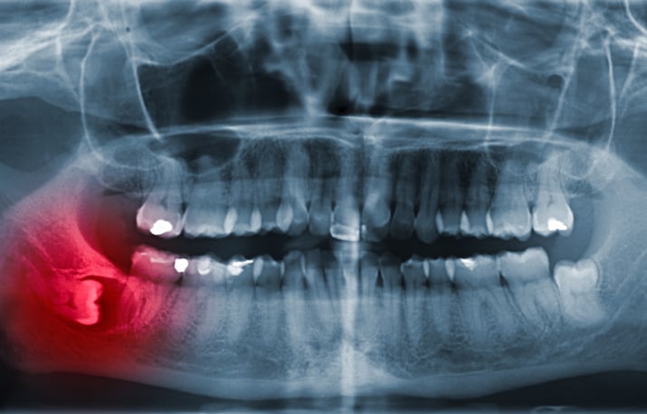 Polaris-Mandibular and tongue reconstruction-anchor