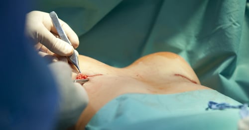 Polaris_Breast Augmentation-2