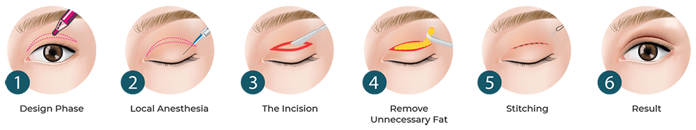 Polaris_incisional-double-eyelid-surgery