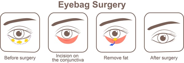 Scarless Eyebag Removal Surgery