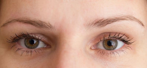 Secondary Blepharoplasty