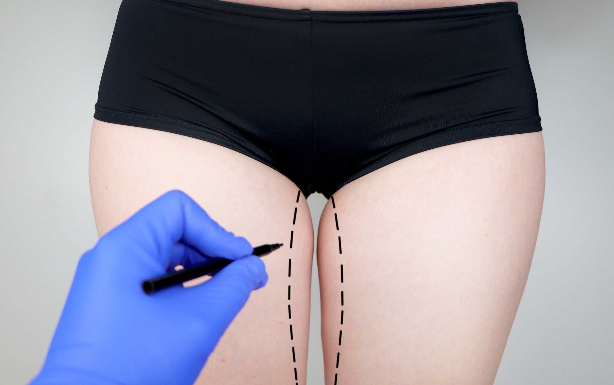 Thigh Lift Thigh Lift