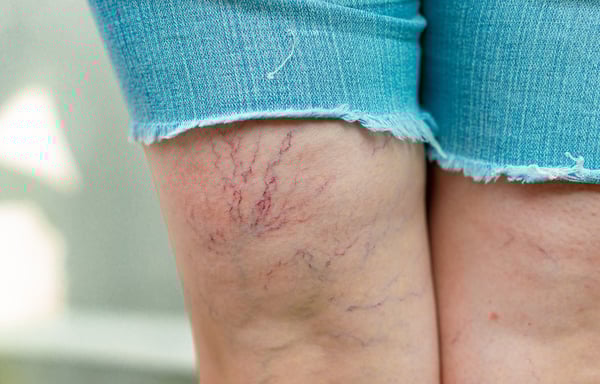 Vessels extremity