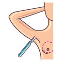 breast implants incision