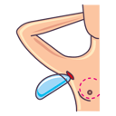 breast implants insertion and stitch