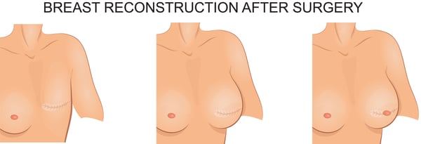 breast reconstruction surgery