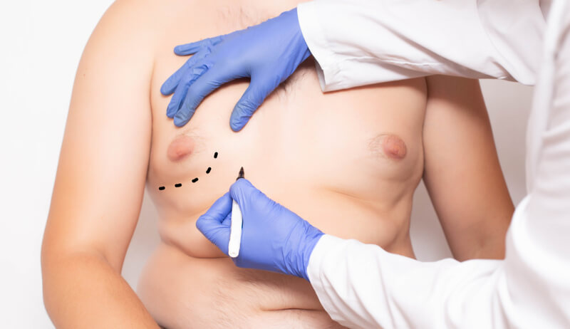 cost for male breast reduction