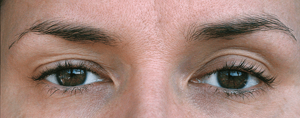 drooping-eyelid