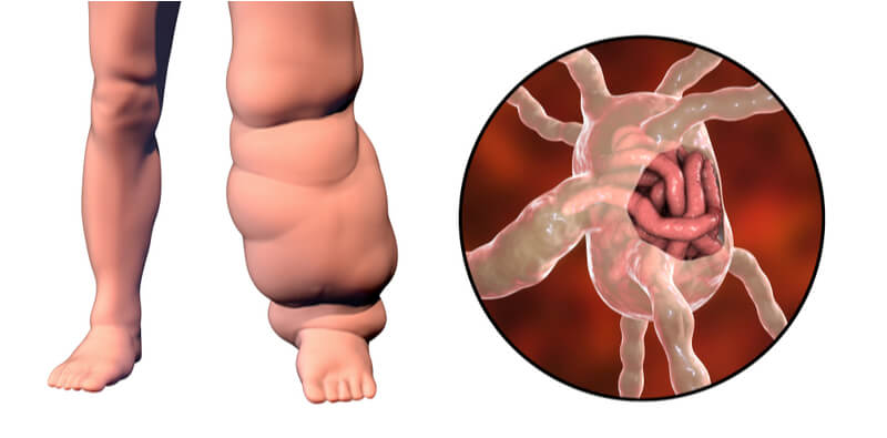 elephantiasis  lymphedema extremity