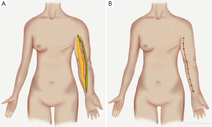 excisional lymphedema surgery-breast cancer patient