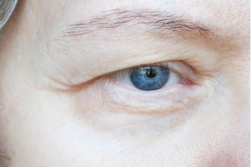 ptosis surgery assessment
