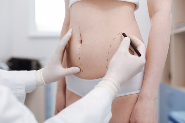 fat grafting sites